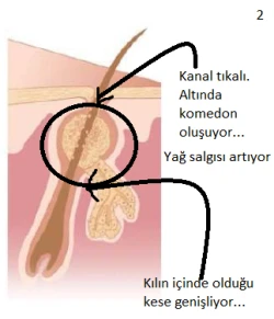 akne2
