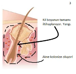 akne3