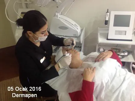 dermapen