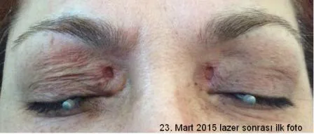 gozlazerdensonra_23mart
